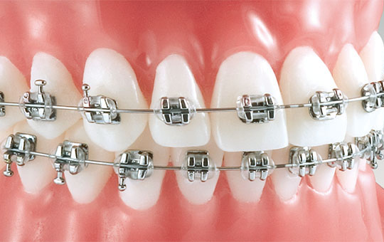 Instrumental para realizar ortodoncias