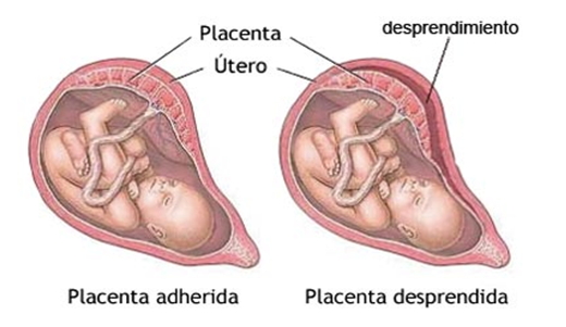 Desprendimiento de placenta