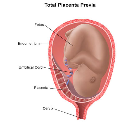 La placenta previa